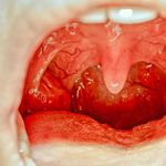 10 Home Remedies for Tonsillitis