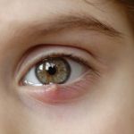 10 Home Remedies for Styes