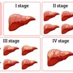 10 Treatments for Liver Cancer