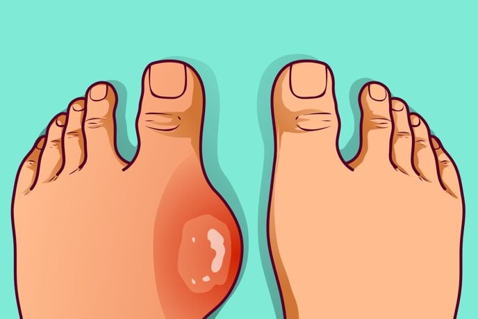 24 Home Remedies for Gout
