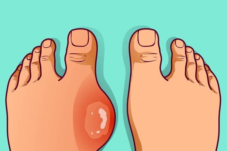 24 Home Remedies for Gout