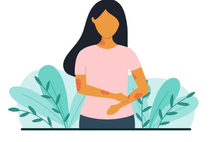 Discover the Power of 10 Natural Remedies for Hives