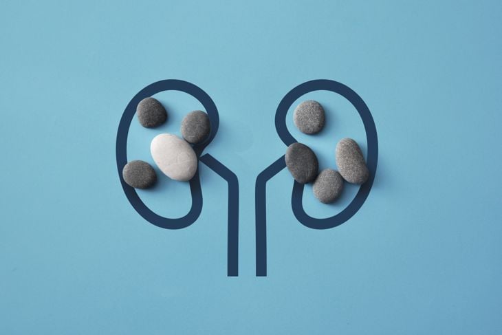10 Home Remedies for Kidney Stones