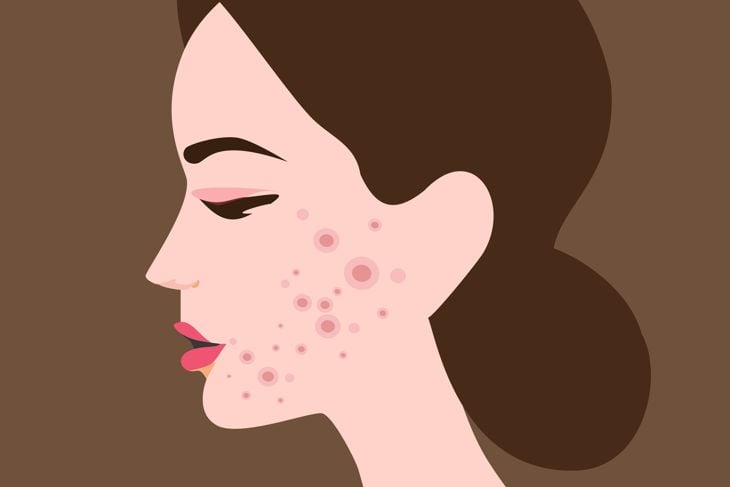 Discover 10 Effective Home Remedies for Acne
