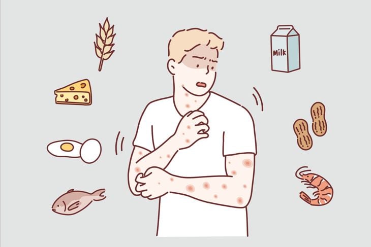 Man with skin allergy and itching caused by food allergies such as shrimp, milk, egg, and peanuts