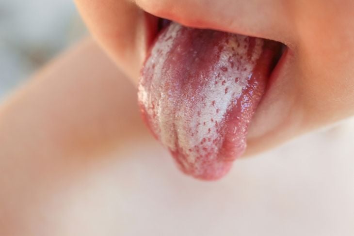 Discover the Power of 10 Home Remedies for Thrush