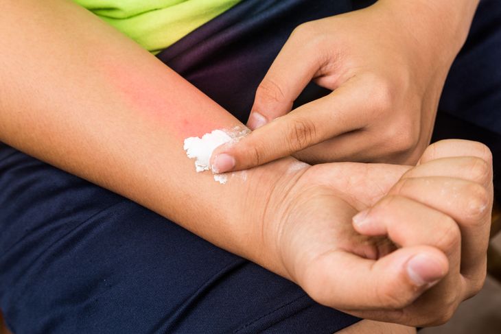 Baking soda being used to relieve itching from rashes