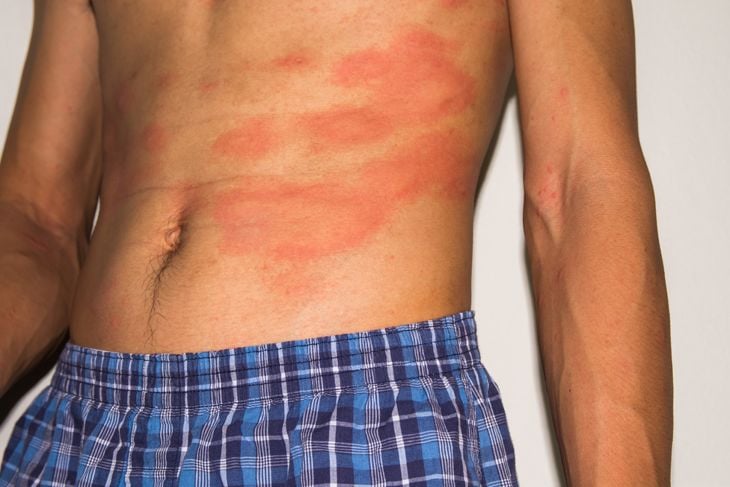 10 Additional Home Remedies for Eczema