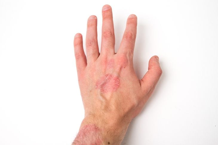 10 Home Remedies for Psoriasis