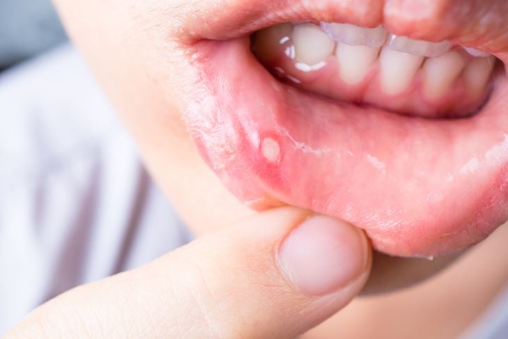 Effective Home Remedies: 10 Ways to Treat Canker Sores
