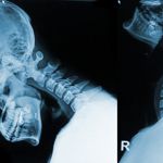 10 Treatments of Cervical Spondylosis