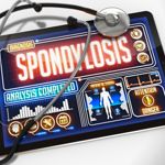 10 Symptoms of Cervical Spondylosis