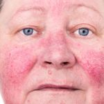 10 steps to treat Rosacea at home
