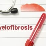 10 Myelofibrosis Symptoms That Are Easy to Overlook