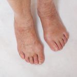 Understanding the Causes of Metatarsalgia