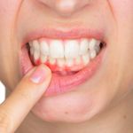 10 Home Remedies for Gingivitis