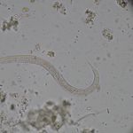 10 Symptoms of Hookworm
