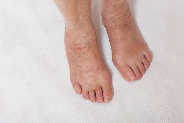 Understanding the Causes of Metatarsalgia