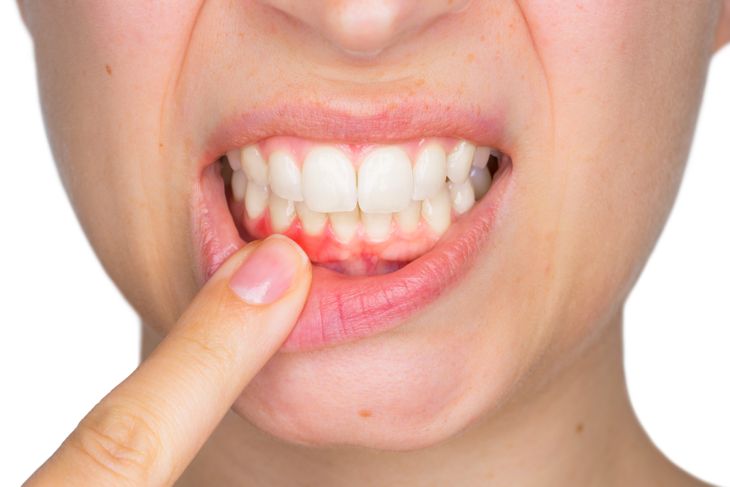 10 Home Remedies for Gingivitis
