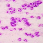 11 Symptoms of Bacterial Infection