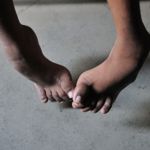 10 Causes and Treatments of Spina Bifida