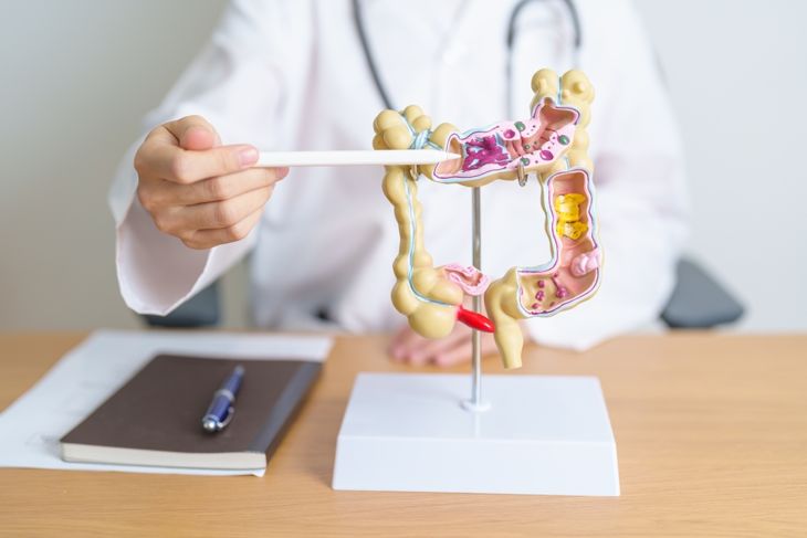 Important Tips for Managing Diverticulosis