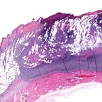 10 Symptoms of Staph Infection