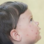 10 Symptoms of Roseola