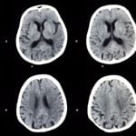 10 Common Brain Diseases