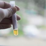 What is a Urine Specific Gravity Test?