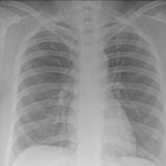8 Key Facts About Bone Marrow Biopsies