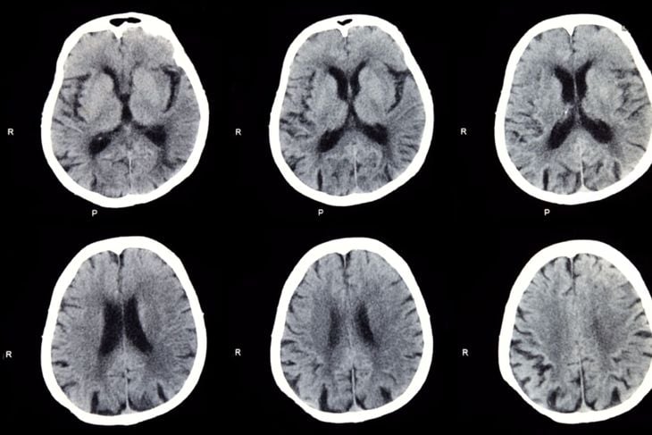 10 Common Brain Diseases