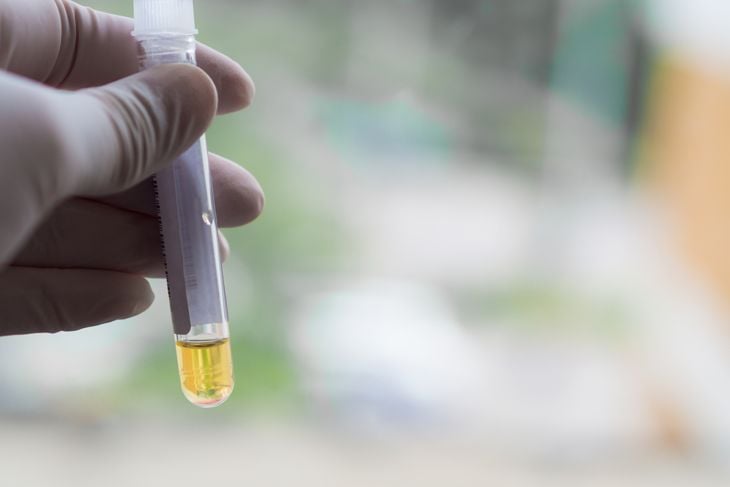 What is a Urine Specific Gravity Test?