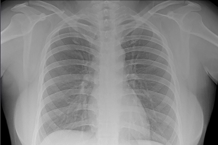 8 Key Facts About Bone Marrow Biopsies
