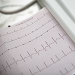 10 Symptoms of Atrial Fibrillation to Watch Out For
