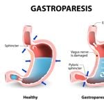 Gastroparesis: A Comprehensive Guide to its Ten Causes