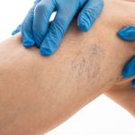 Quick and Easy Varicose Vein Treatments