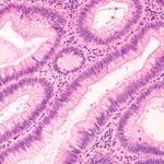 10 Common Colon Polyp Types