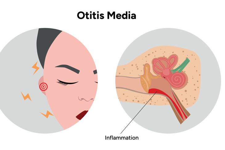 Otitis media inflammation anatomy human ear pain disease medical infographic