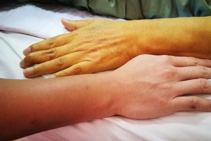 The 10 Health Conditions That Can Trigger Jaundice