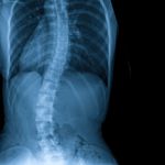 Understanding scoliosis: causes and treatment options.