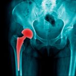 10 Tips for Recovery from Total Hip Replacement