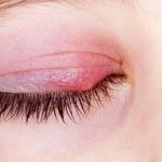 13 Causes of Red Eye