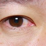 Treatments for Pink Eye