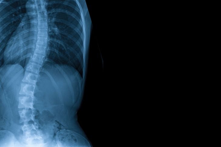 Understanding scoliosis: causes and treatment options.