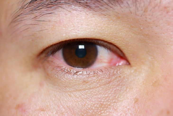 Treatments for Pink Eye