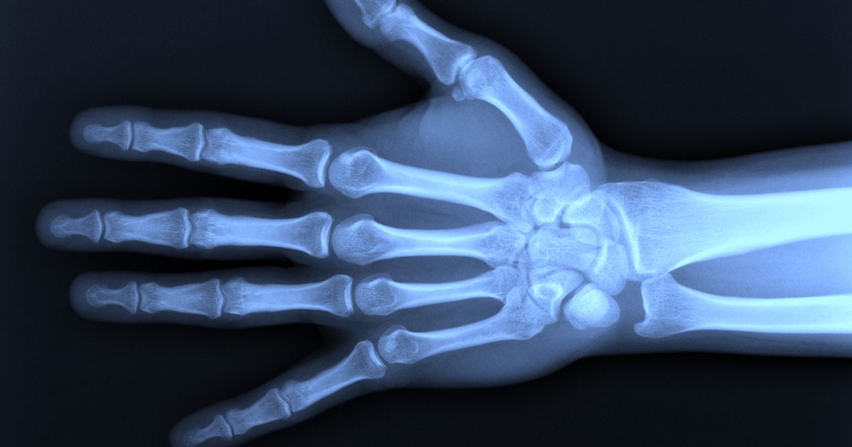 10 Symptoms and Treatments of Mallet Finger Facty Health