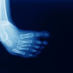 What is Clubfoot? Treatments and Symptoms