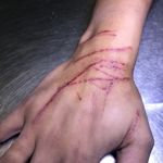 Cat Scratch Disease: A Comprehensive Guide to its Symptoms and Treatments