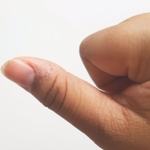 What is Paronychia?